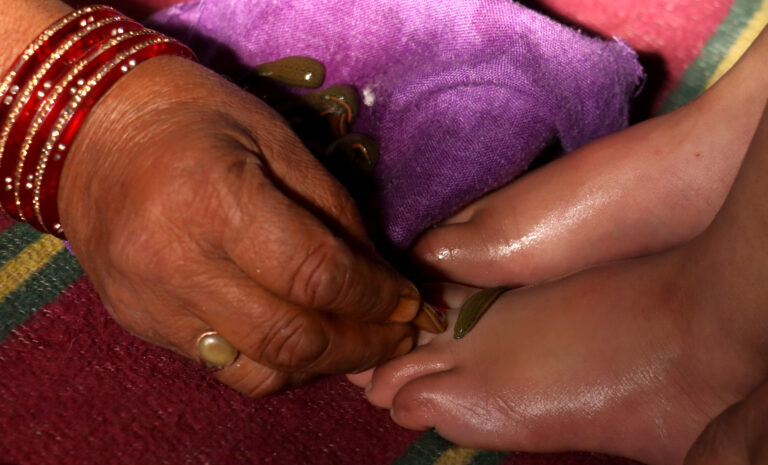 A-patient-receives-leech-therapy-in-Srinagar-3
